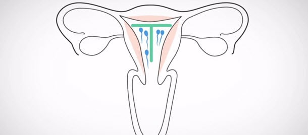 Спираль для женщин от беременности цена thumbnail